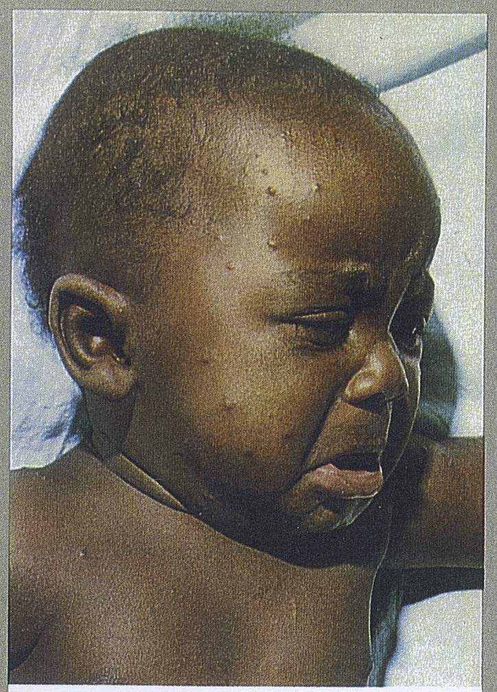 W.H.O. photo of baby with very mild smallpox