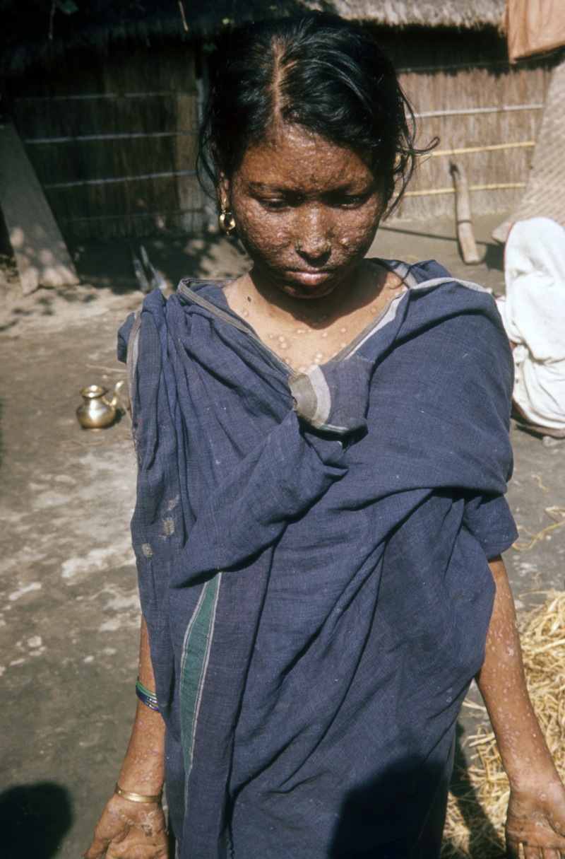 Bangladesh - woman with smallpox, 1975